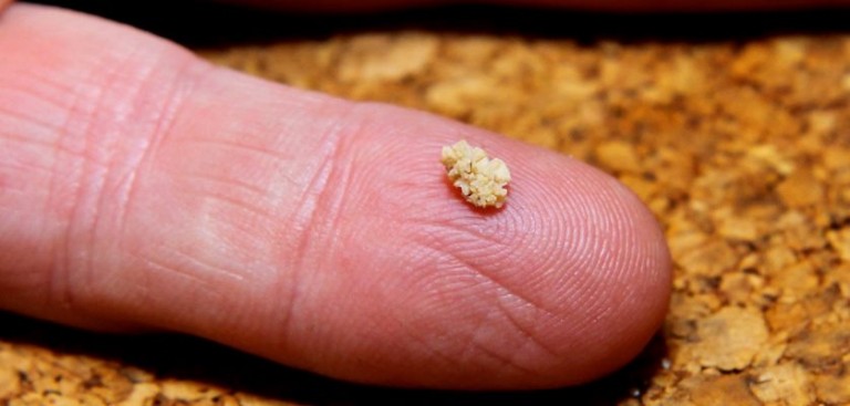 ¿Qué son las piedras en el riñón? | Blog de Antonio Game