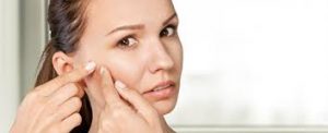 Tratamiento Acné Hormonal